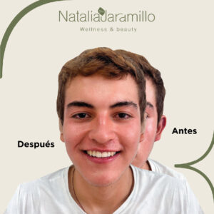 El procedimiento es excelente, quedé súper feliz, ya hace más de un año que me lo hice y me encantó, mi autoestima mejoró me encantó