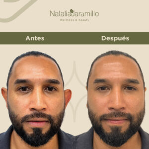 Mi experiencia con la Dra. Natalia Jaramillo fue muy buena, me sentí bien atendido y la doctora fue muy profesional y amable.
Definitivamente la recomiendo, me ayudó mucho y estoy satisfecho con el procedimiento . ¡Gracias por el excelente servicio!